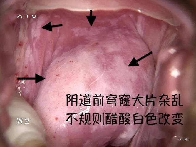 阴道炎症