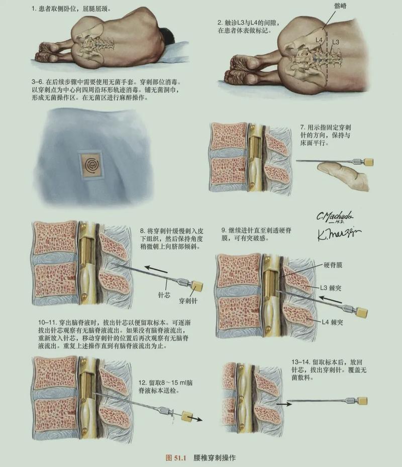 穿刺过程