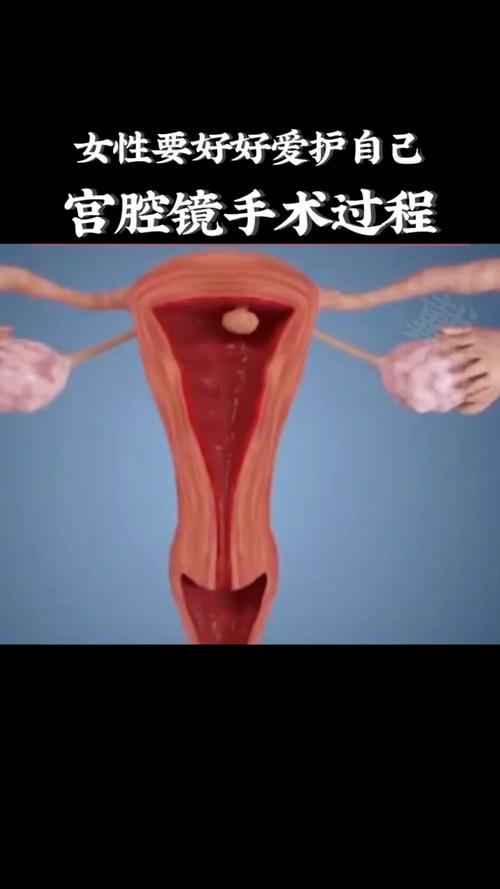  宫腔镜手术