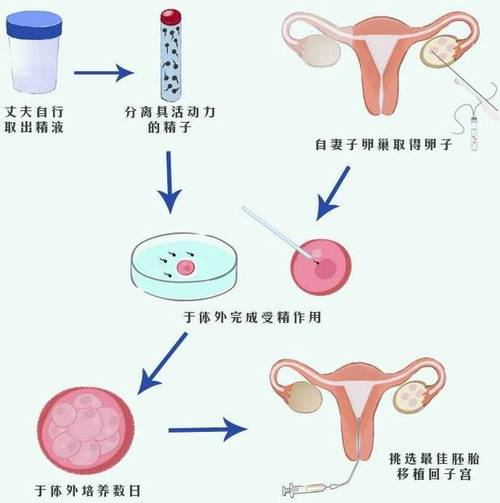 试管婴儿过程中通常需要几个卵泡才能成功？