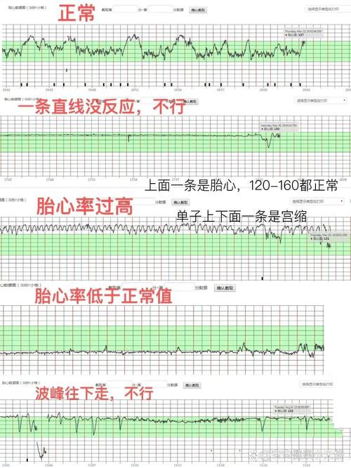 胎心检查