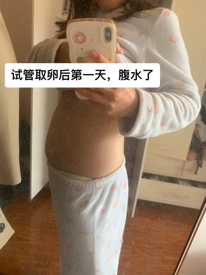 试管婴儿移植后腹水