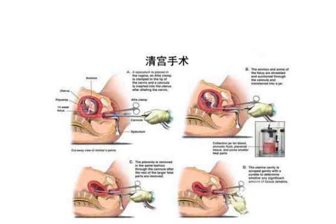 生殖系统手术