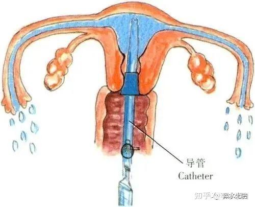 试管婴儿移植过程中的痛苦与心理承受究竟有多大？