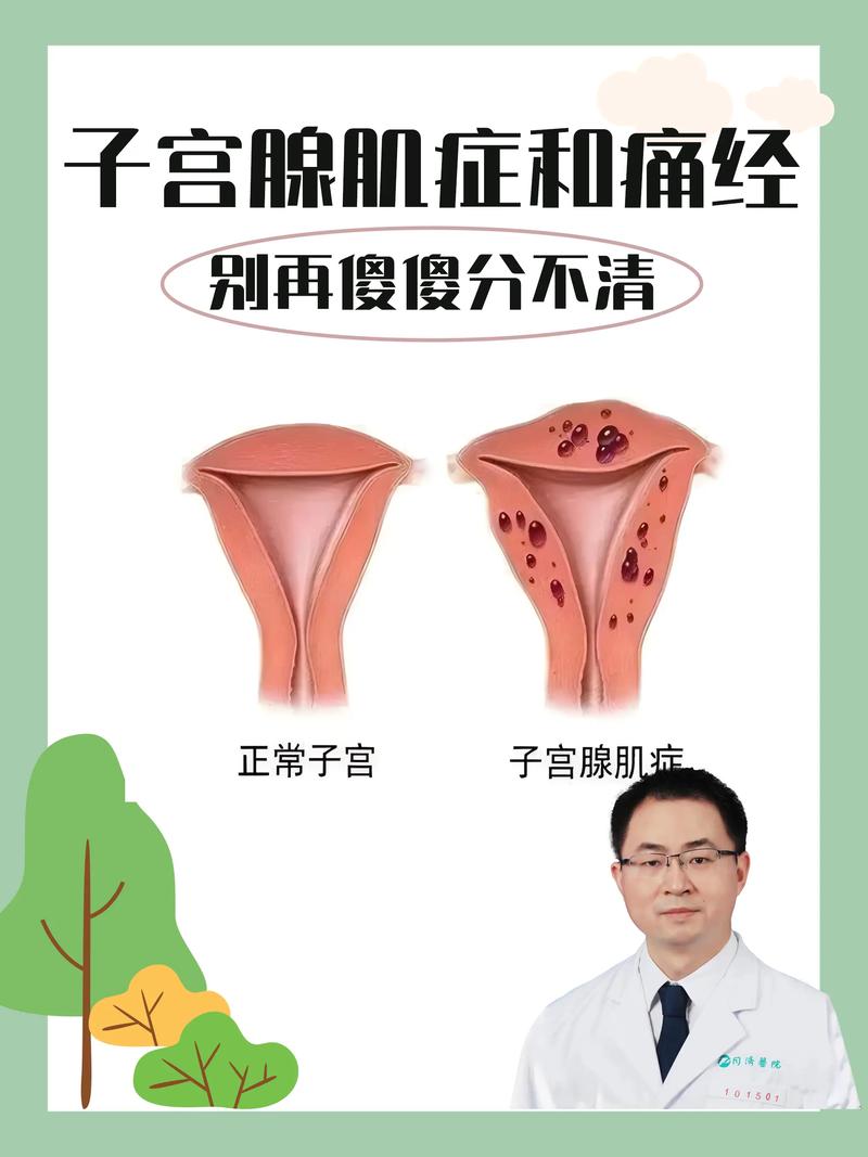 子宫肌腺症