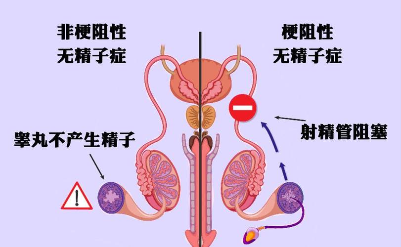 梗阻性无精症