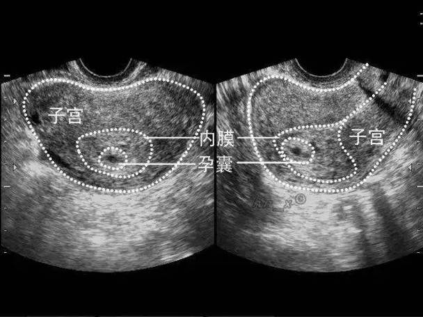 B 超未见胚芽