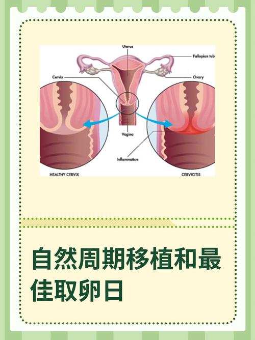  自然周期取卵