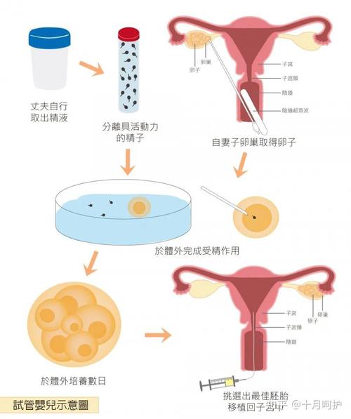 一代试管婴儿：究竟有多接近自然受孕的过程？