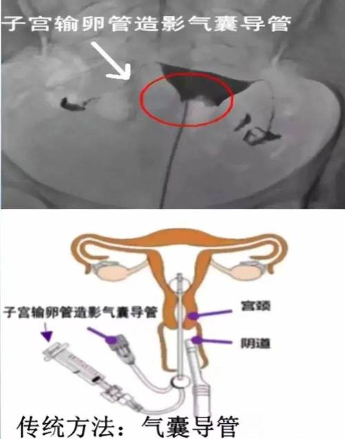 输卵管通透性检查