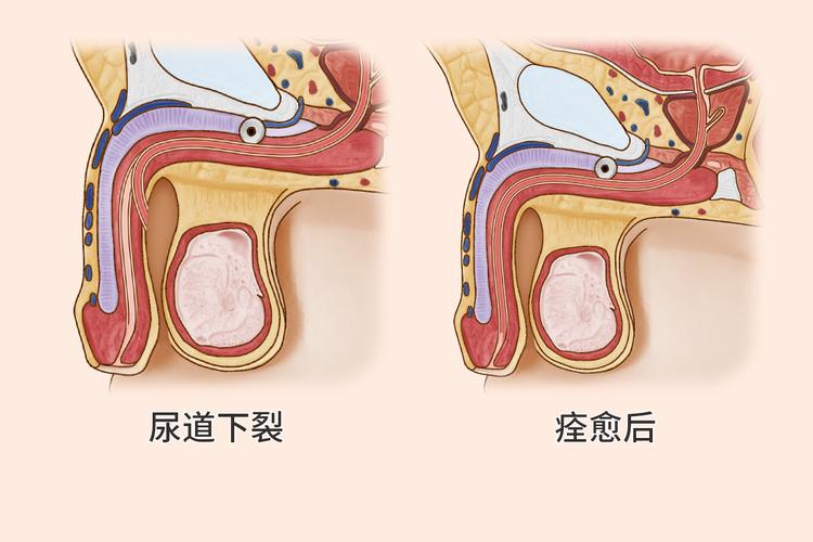  尿道下裂