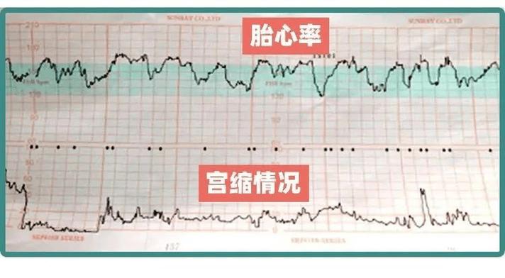 7 周胎心监测