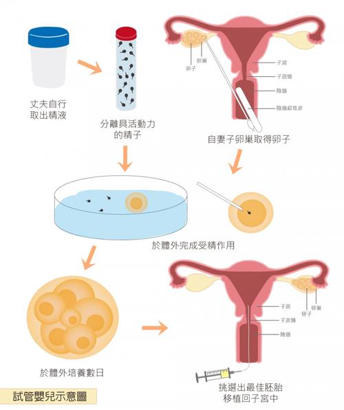 试管婴儿移植如何进行？是放在宫腔里吗？