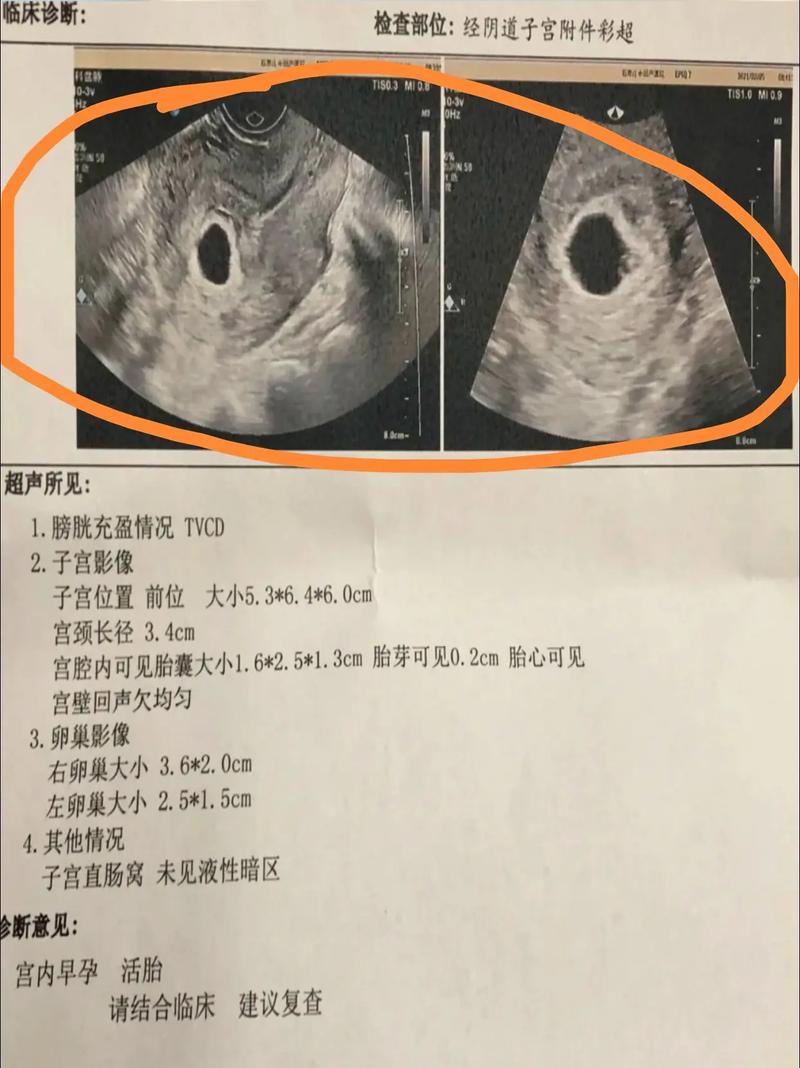 试管婴儿六周胎心未能检测到该如何应对？