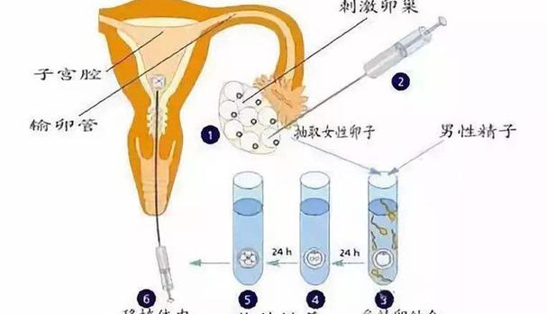 试管婴儿过程中通常会产生多少个卵泡？