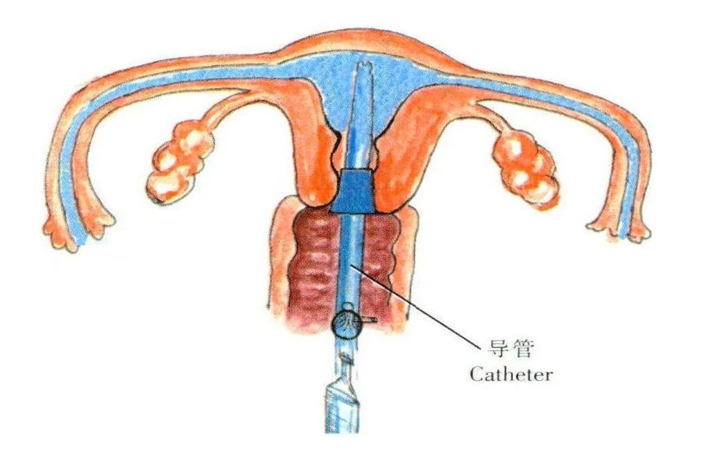  宫腔灌注