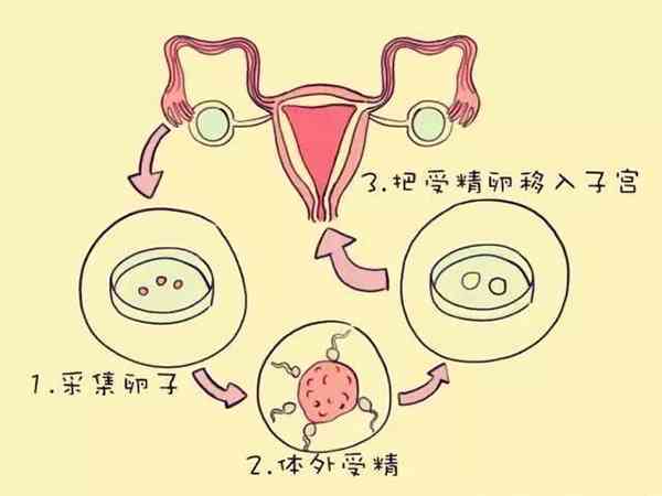 试管婴儿的形成过程：是否通过输卵管进入？