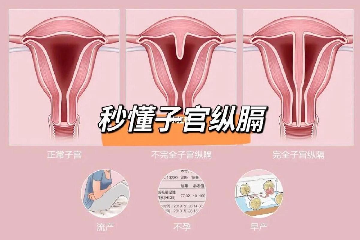 胚胎放置宫腔