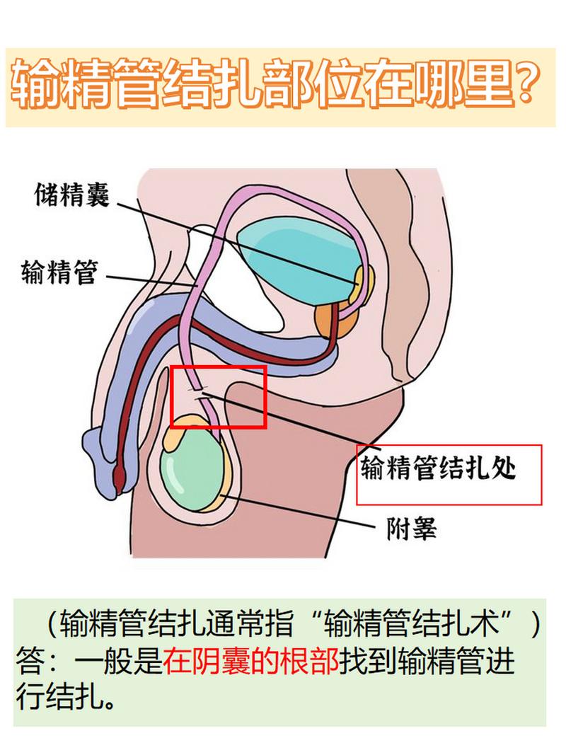 输精管结扎