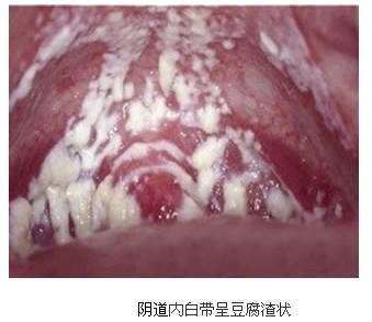  分泌物变化