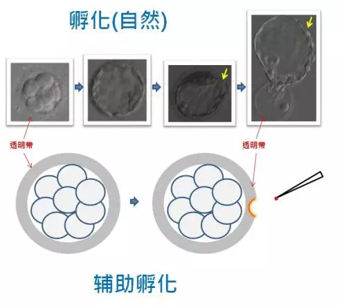 试管辅助孵化技术