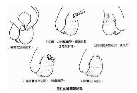  输精管结扎术