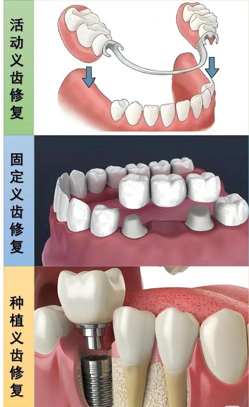  口腔修复