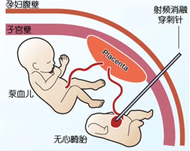 双胎减胎手术