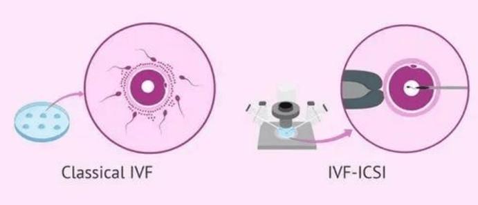  体外受精技术（IVF）